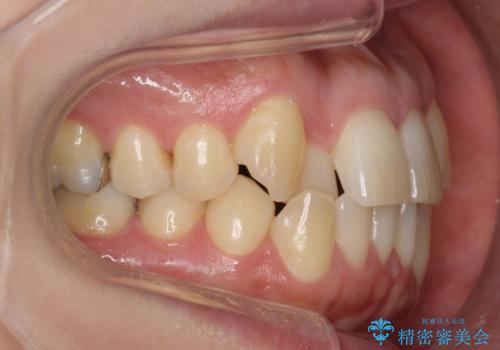 40代の矯正 八重歯を綺麗に の治療前