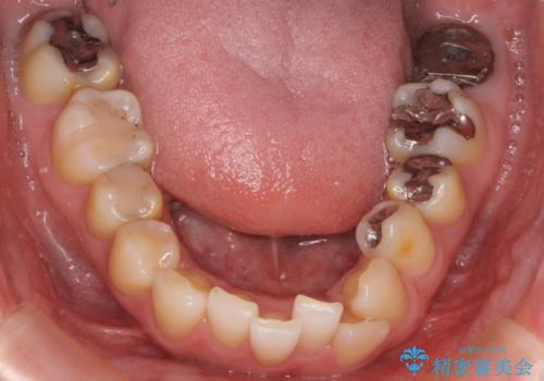前歯の歯並びが気になる　マウスピース矯正　30代女性の治療前