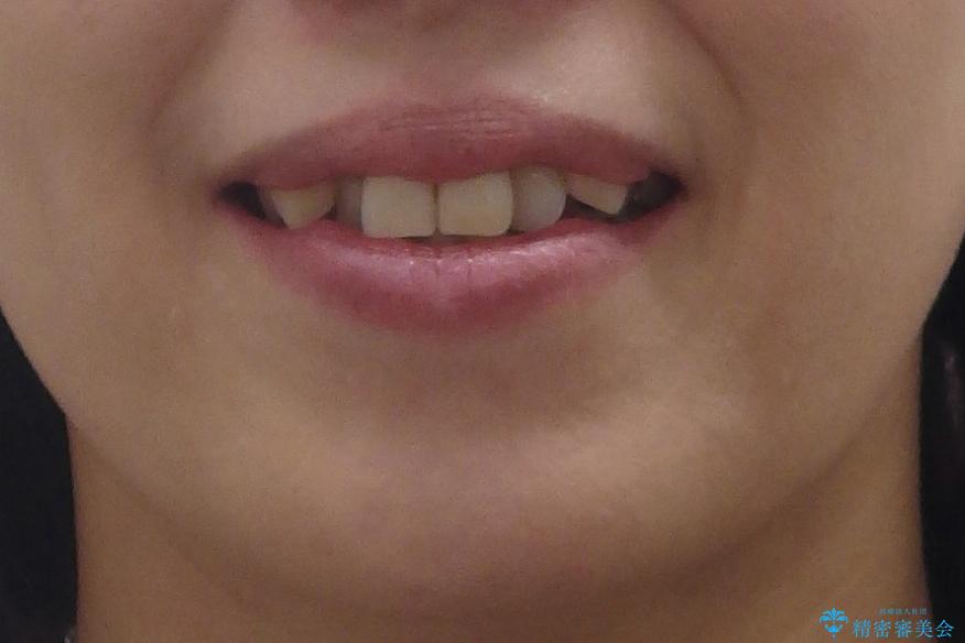 40代の矯正 八重歯を綺麗に の治療前(顔貌)