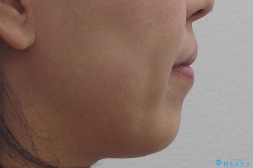 40代の矯正 八重歯を綺麗に の治療前(顔貌)