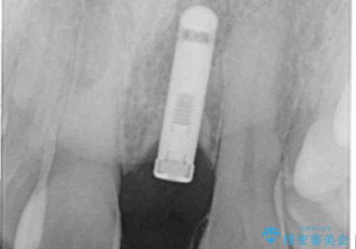 他院で治療したインプラント セラミッククラウンの装着の治療前