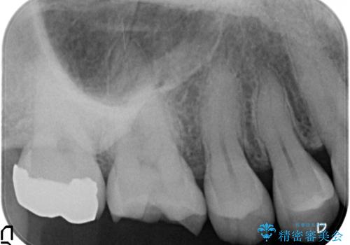 目立つ銀歯を白くしたい セラミック治療の治療前