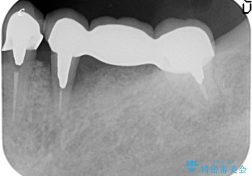 ブリッジ支台の歯の痛み インプラントによる咬合負担の治療前