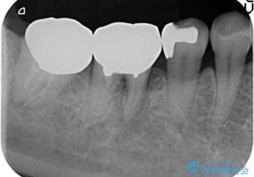 歯ぐきの腫れが治らない　石灰化した狭小根管治療の治療前