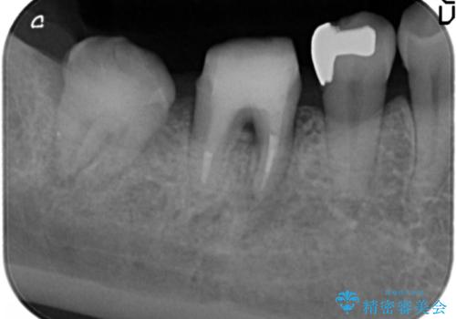 歯ぐきの腫れが治らない 石灰化した狭小根管治療の治療中