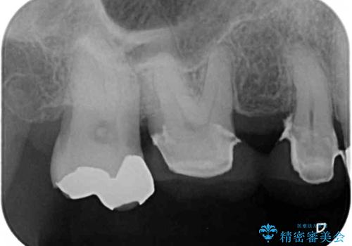 奥歯の歯槽骨が失われた　歯周外科処置後のセラミックブリッジの治療前