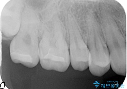 セラミックインレー 奥歯の治療の治療後