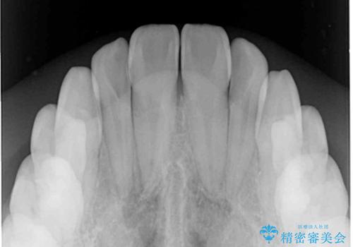 奥歯の反対咬合 上顎骨を拡大してインビザラインで矯正の治療後
