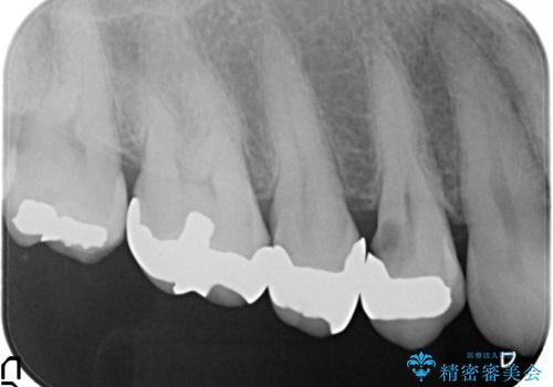オールセラミッククラウン(エクセレント) 神経まで達してしまった虫歯の治療の治療前