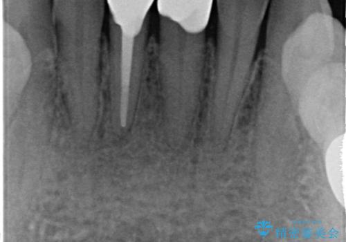 オールセラミッククラウン(スペシャル) 見た目が気になる前歯を綺麗にの治療後