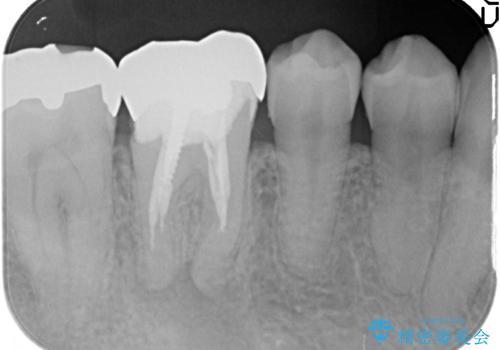 オールセラミッククラウン 咬むと疼く銀歯の治療の治療前