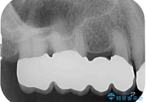 奥歯の歯槽骨が失われた　歯周外科処置後のセラミックブリッジの治療後