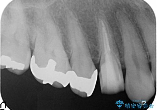オールセラミッククラウン(エクセレント) 神経まで達してしまった虫歯の治療の治療中
