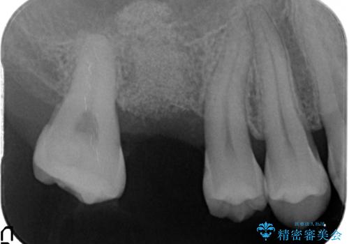 ソケットリフトを伴うインプラント補綴 の治療前
