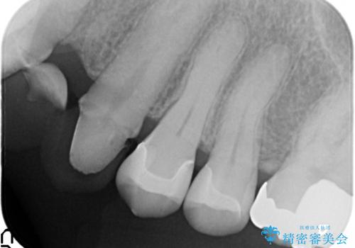 セラミックインレー 脱離した銀歯の治療の治療後