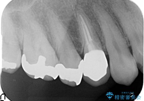 オールセラミッククラウン(エクセレント) 神経まで達してしまった虫歯の治療の治療後