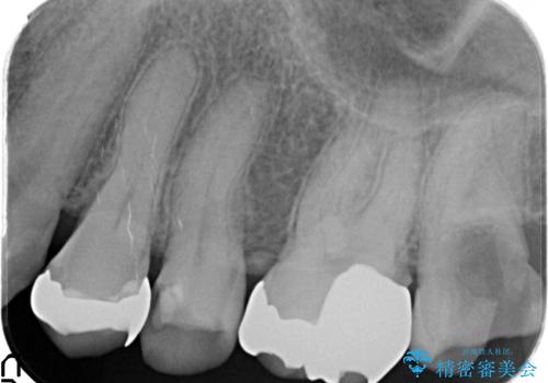 セラミックインレー 脱離した銀歯の治療の治療前