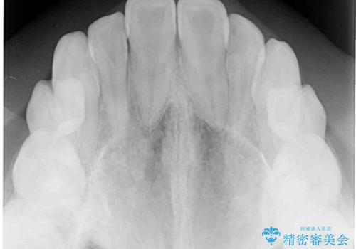 奥歯の反対咬合 上顎骨を拡大してインビザラインで矯正の治療前