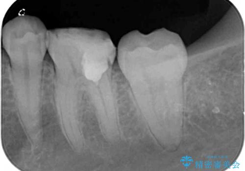 大きな虫歯で歯が欠けた　神経を極力残した治療の治療中