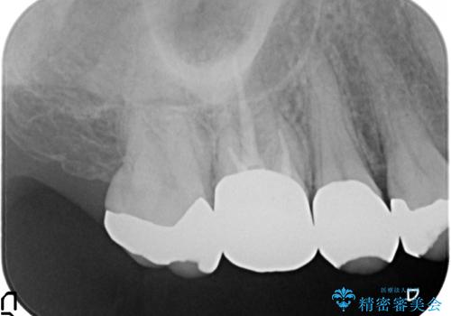 オールセラミッククラウン 咬合痛のある歯の治療の治療前