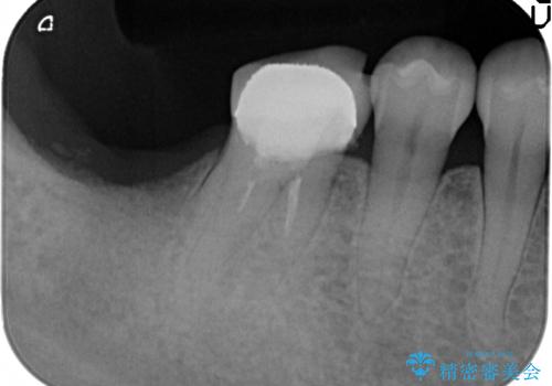 奥歯　インプラントによる機能回復の治療前