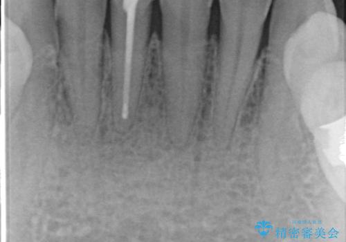 オールセラミッククラウン(スペシャル) 見た目が気になる前歯を綺麗にの治療前
