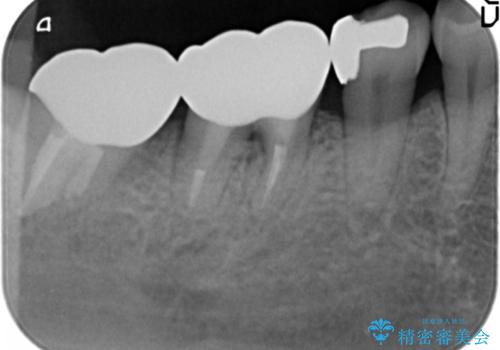 歯ぐきの腫れが治らない 石灰化した狭小根管治療の治療後