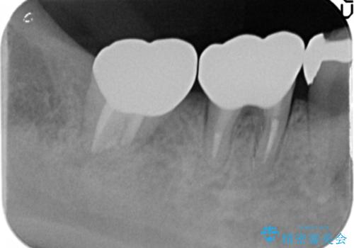 歯ぐきの腫れが治らない　石灰化した狭小根管治療の治療後