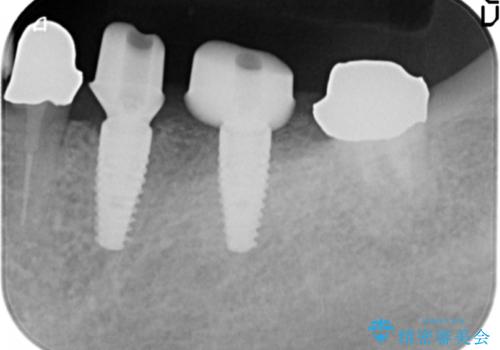 ブリッジ支台の歯の痛み　インプラントによる咬合負担の治療中
