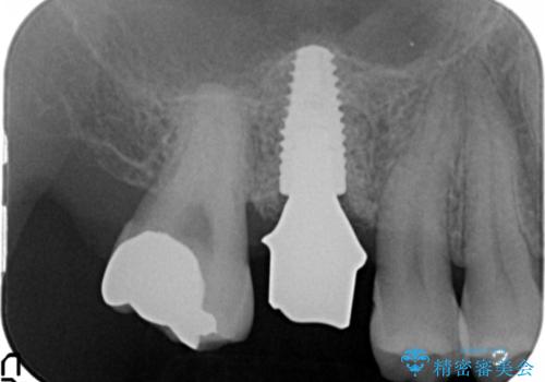 ソケットリフトを伴うインプラント補綴 の治療中