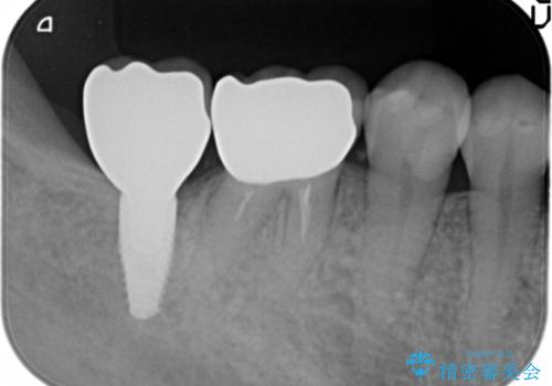 奥歯　インプラントによる機能回復の治療後