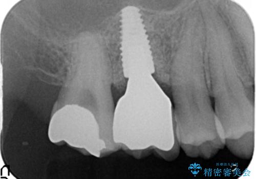 ソケットリフトを伴うインプラント補綴 の治療後