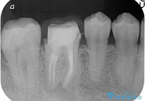 オールセラミッククラウン 咬むと疼く銀歯の治療の治療中
