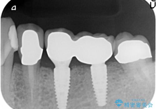 ブリッジ支台の歯の痛み　インプラントによる咬合負担
