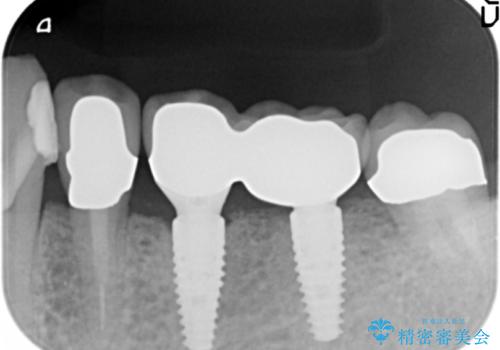 ブリッジ支台の歯の痛み　インプラントによる咬合負担の治療後