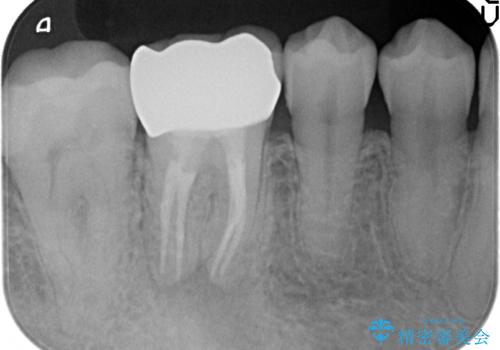 オールセラミッククラウン 咬むと疼く銀歯の治療の治療後