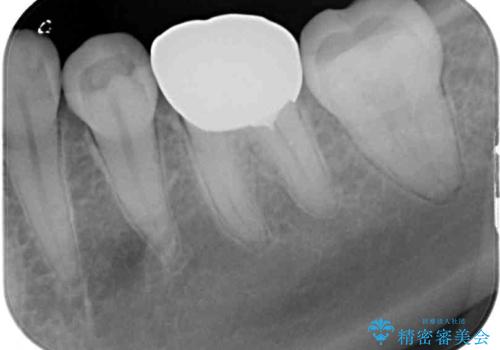 大きな虫歯で歯が欠けた　神経を極力残した治療の治療後