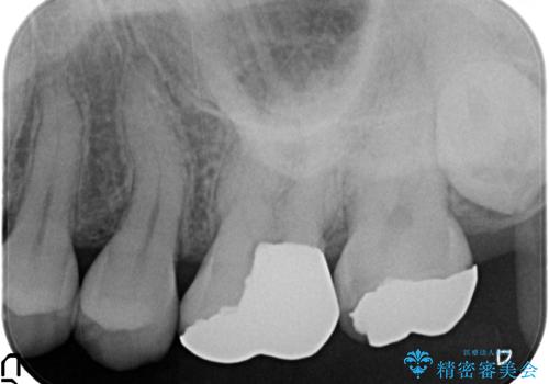 目立つ銀歯を白くしたい セラミック治療の治療前