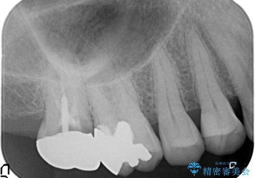 歯髄方向 歯肉方向へと深い 2種類の大きな虫歯の治療前