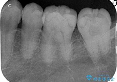 保険適応の白い詰め物レジンインレー下に再発した大きな虫歯治療の治療前