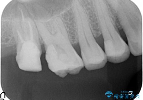 歯髄方向 歯肉方向へと深い 2種類の大きな虫歯の治療中