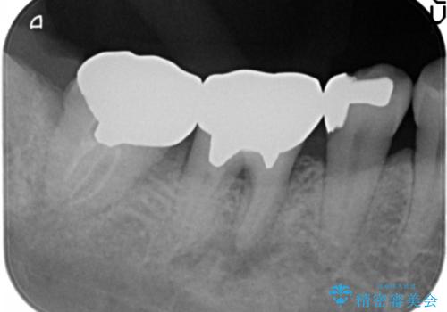 歯ぐきの腫れが治らない　石灰化した狭小根管治療の治療前