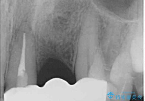 歯肉移植を用いた前歯のオールセラミックブリッジの治療後