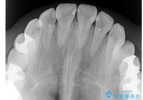 上顎骨拡大を併用したインビザライン矯正の治療後