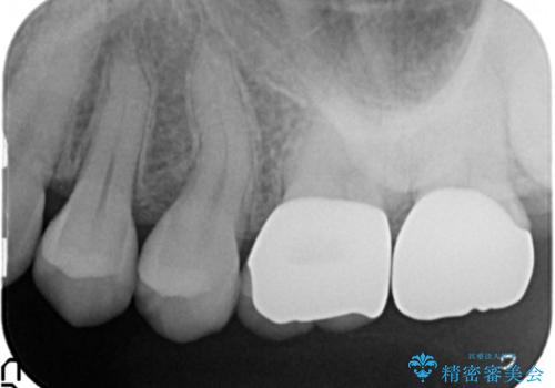 目立つ銀歯を白くしたい セラミック治療の治療後