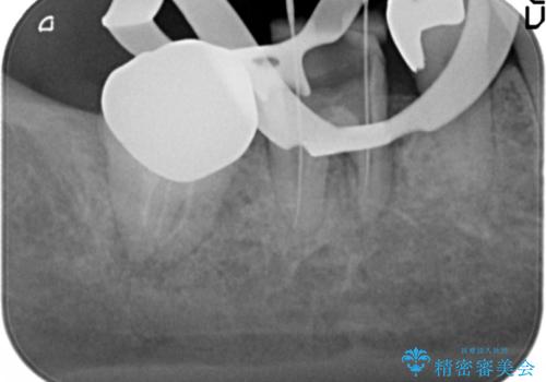 歯ぐきの腫れが治らない 石灰化した狭小根管治療の治療中