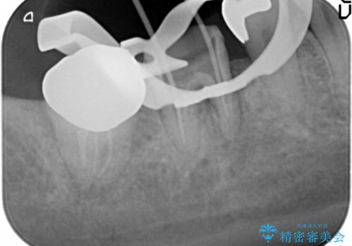 歯ぐきの腫れが治らない　石灰化した狭小根管治療の治療中