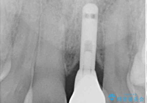 他院で治療したインプラント セラミッククラウンの装着の治療後