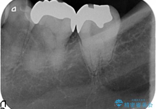 保険適応の白い詰め物レジンインレー下に再発した大きな虫歯治療の治療後