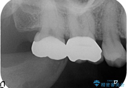 目立つ銀歯を白くしたい セラミック治療の治療後